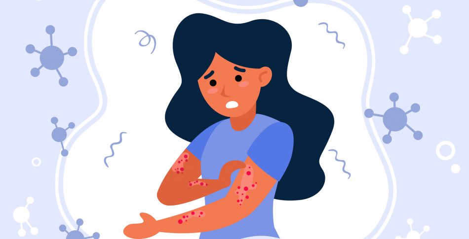 Dålig kondition kopplas till ökad risk för psoriasis